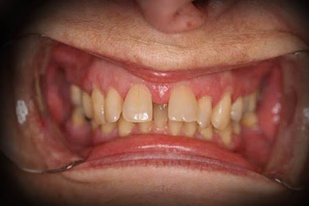 braces before