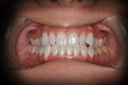 orthodontics before