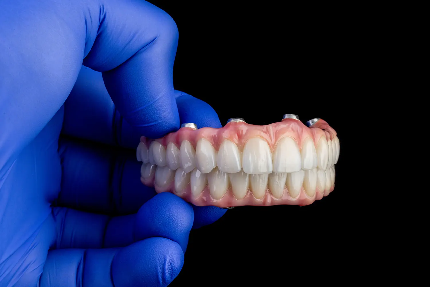 Dental Implants 5