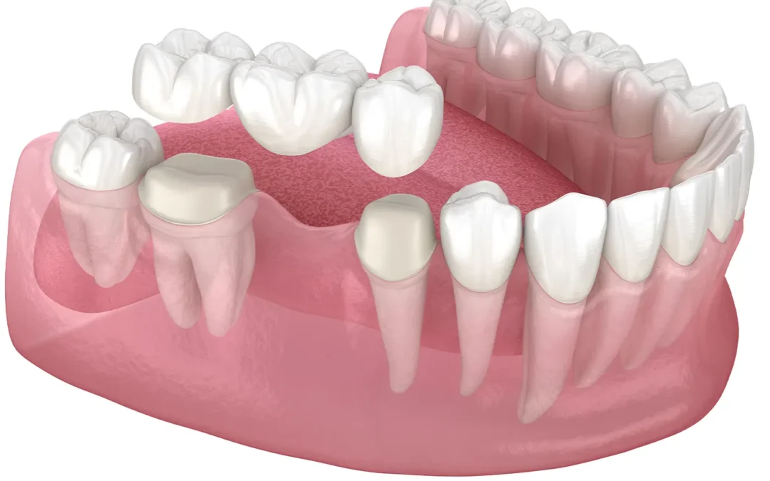 Dental Implant vs. Bridge: Choosing the Right Option for Your Smile