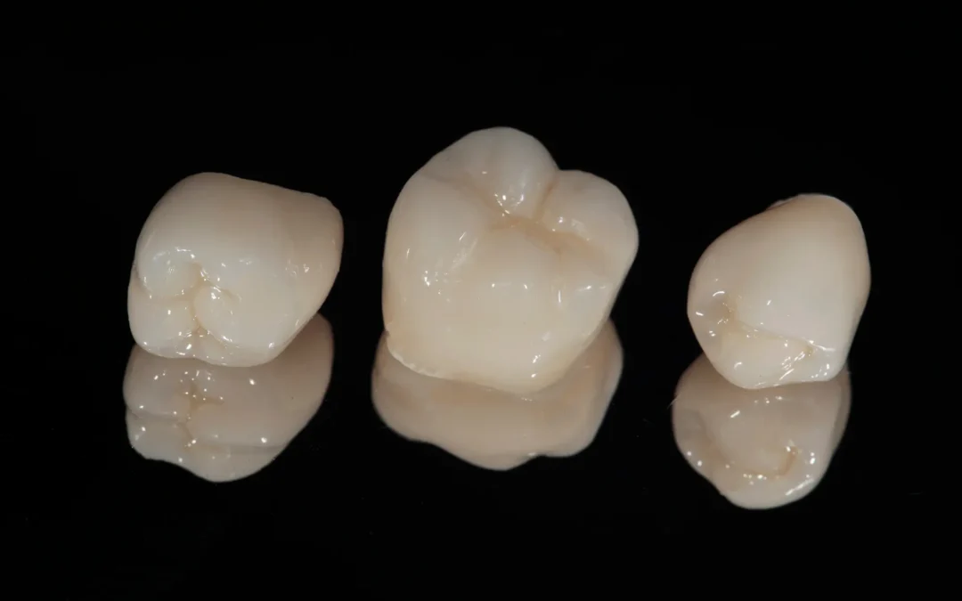 Are CEREC Crowns as Good as Traditional Crowns?